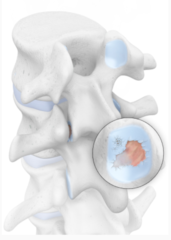 Spondyloarthritis - Arthritis of the Spine