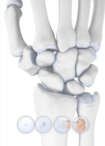Wrist Osteoarthritis - Arthritis in the Wrist Joint