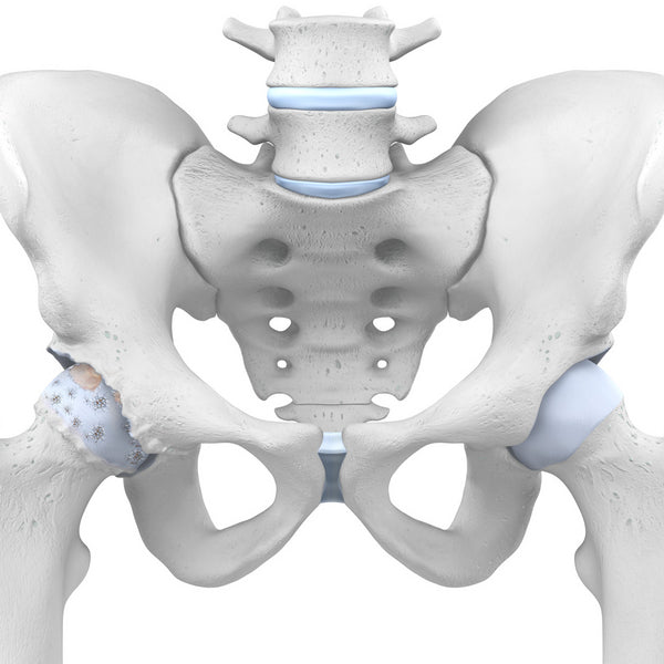 Hip Arthritis: Osteoarthritis of the Hip Joint
